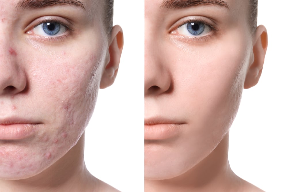 How To Treat Acne - Revolution Aesthetics